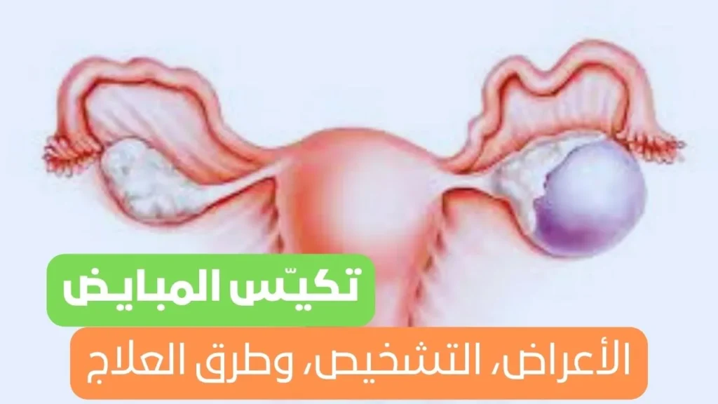 تكيـّس المبـايـض