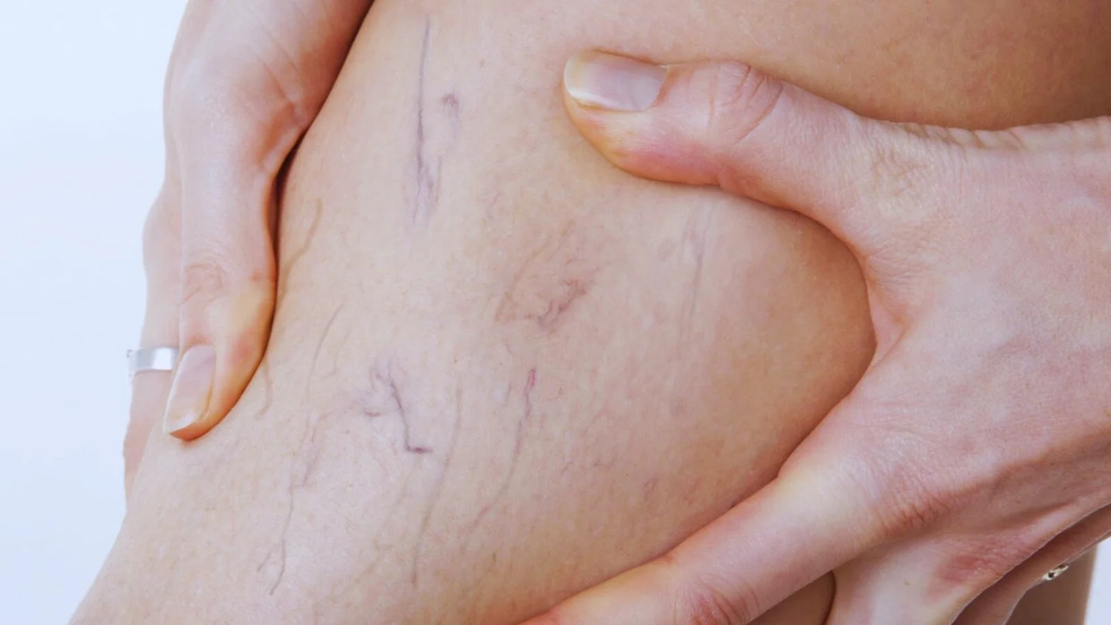 دوالي-الساقين