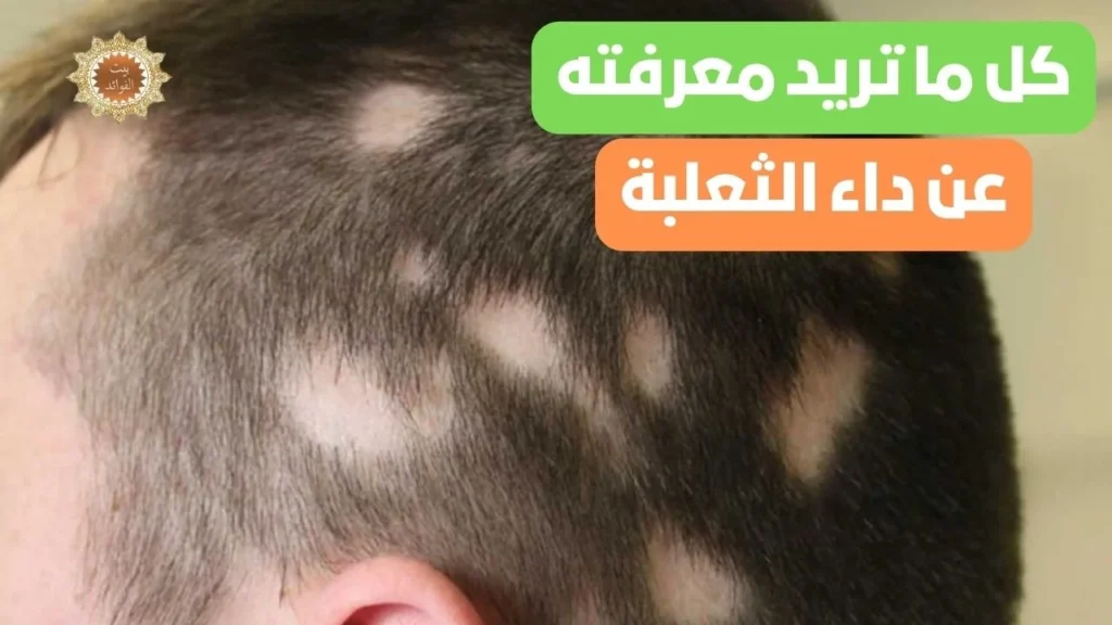 داء الثعلبة