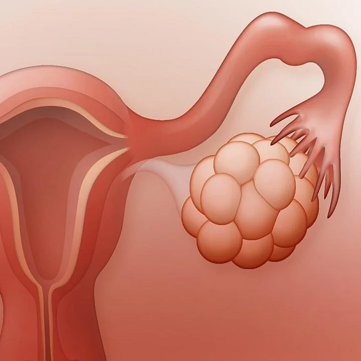 العلاج الطبيعي لتكيس المبايض