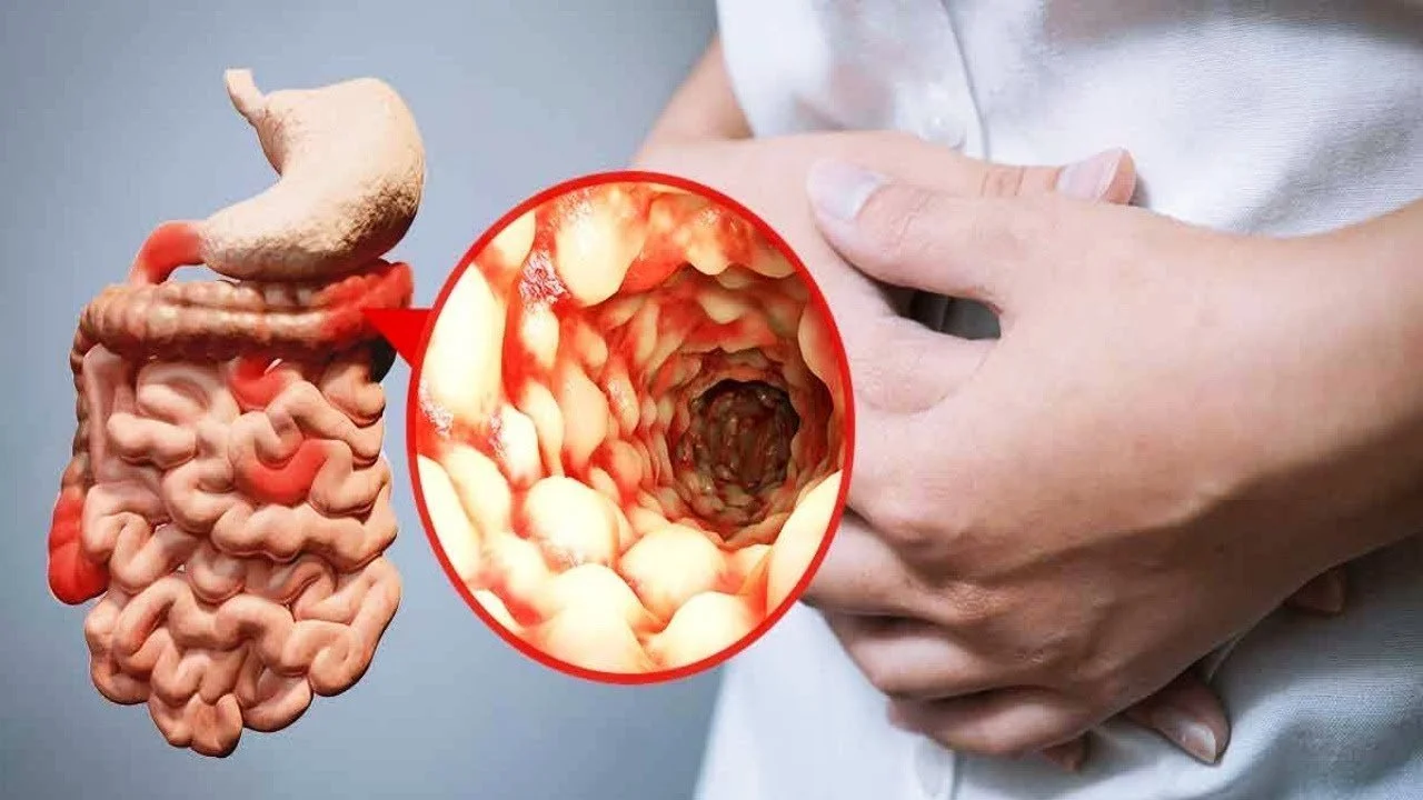 العلاج الطبيعي لمرض كرون